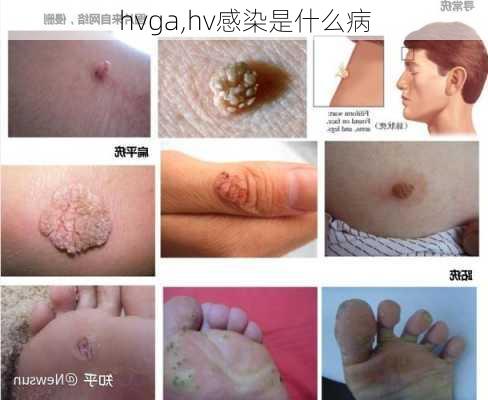 hvga,hv感染是什么病