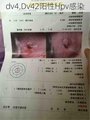 dv4,Dv42阳性Hpv感染